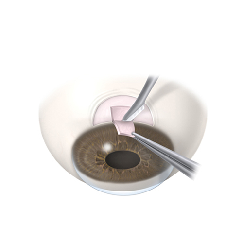 Imágen de un Topógrafo corneal